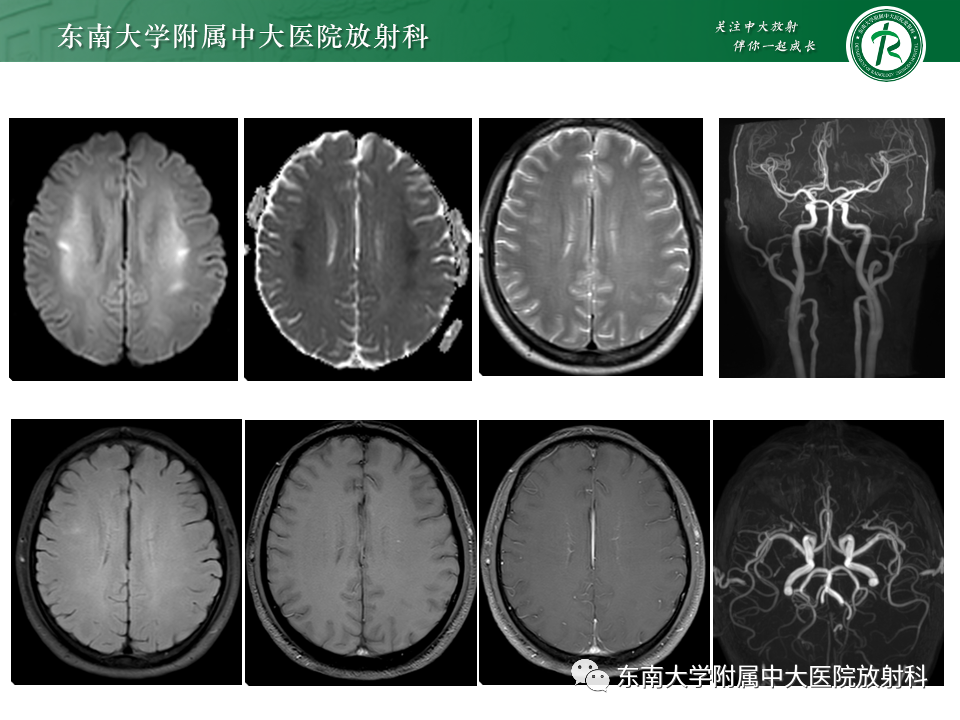 影像PPT - 【PPT】成人常见脑白质病变影像诊断-12
