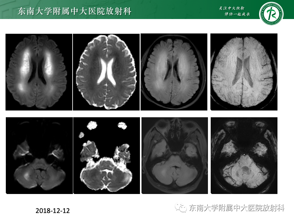 影像PPT - 【PPT】成人常见脑白质病变影像诊断-15