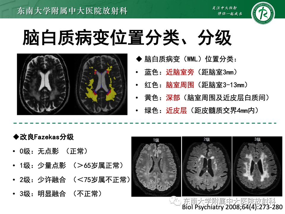 影像PPT - 【PPT】成人常见脑白质病变影像诊断-21