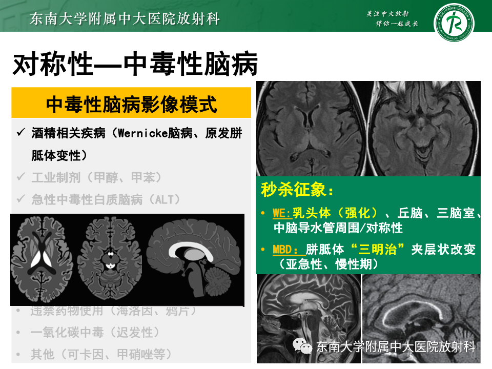 影像PPT - 【PPT】成人常见脑白质病变影像诊断-28
