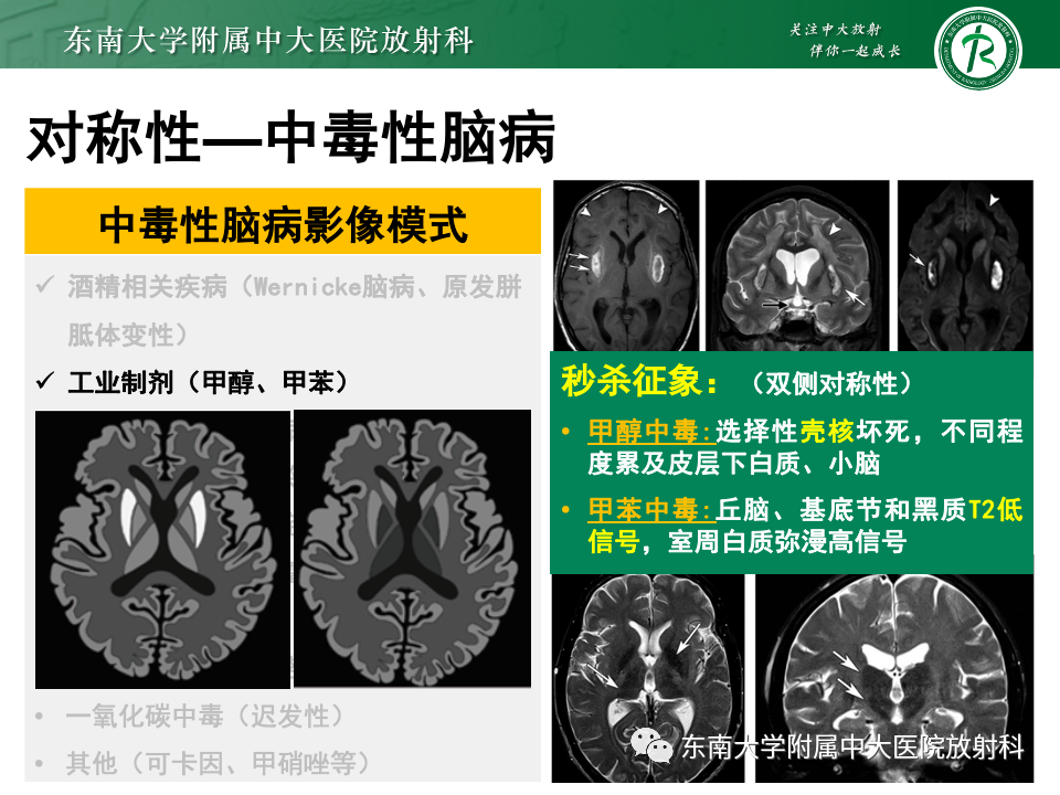 影像PPT - 【PPT】成人常见脑白质病变影像诊断-29
