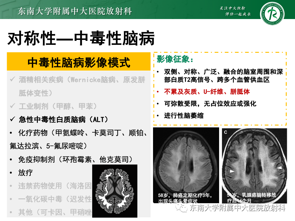 影像PPT - 【PPT】成人常见脑白质病变影像诊断-30