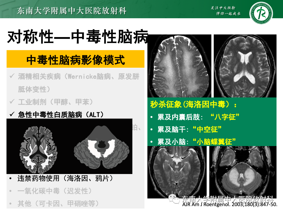 影像PPT - 【PPT】成人常见脑白质病变影像诊断-31