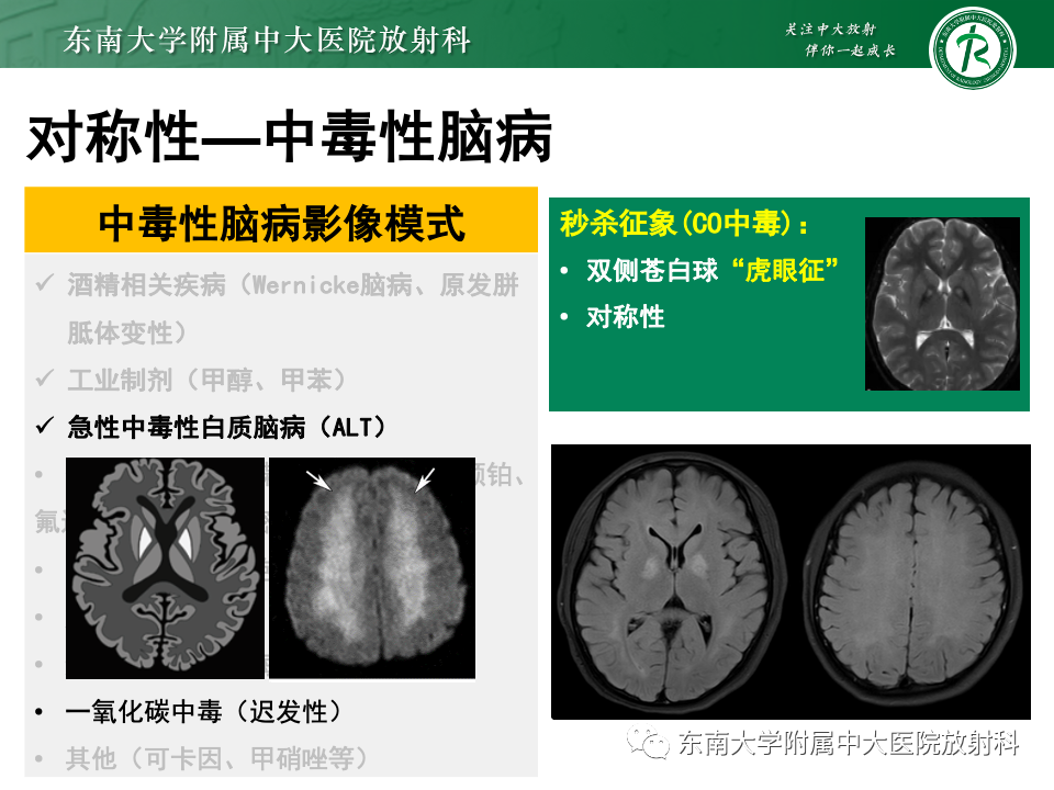 影像PPT - 【PPT】成人常见脑白质病变影像诊断-32