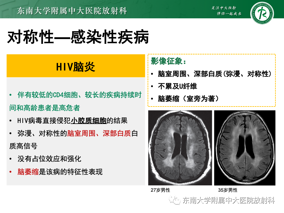 影像PPT - 【PPT】成人常见脑白质病变影像诊断-33