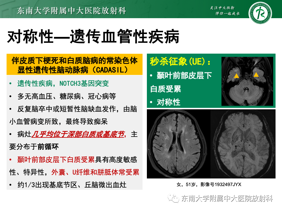 影像PPT - 【PPT】成人常见脑白质病变影像诊断-35