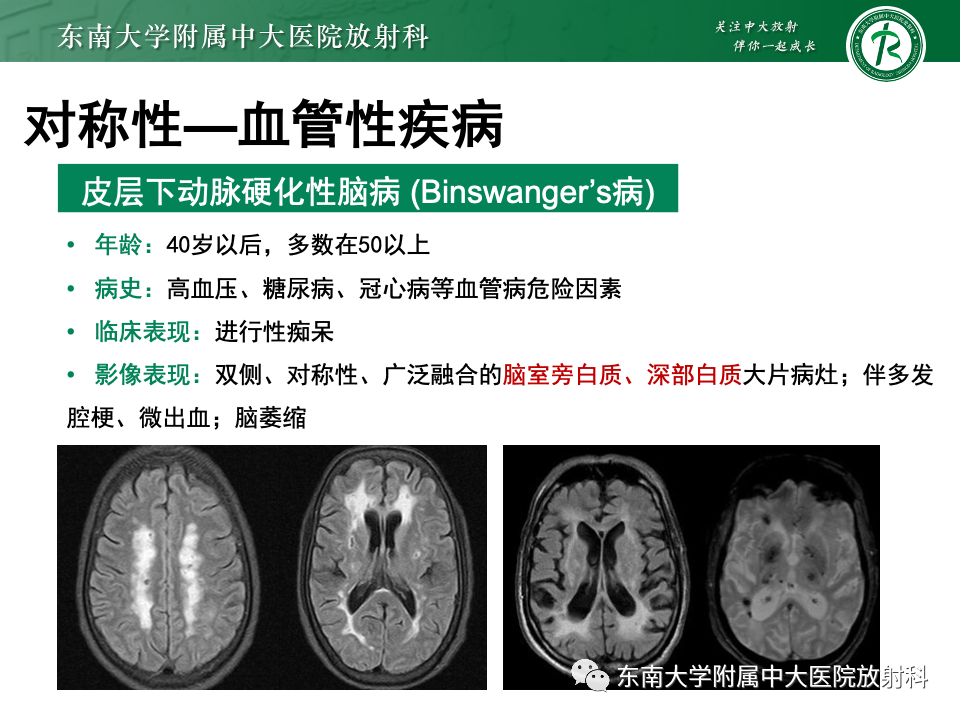 影像PPT - 【PPT】成人常见脑白质病变影像诊断-36