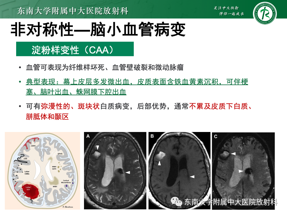 影像PPT - 【PPT】成人常见脑白质病变影像诊断-38