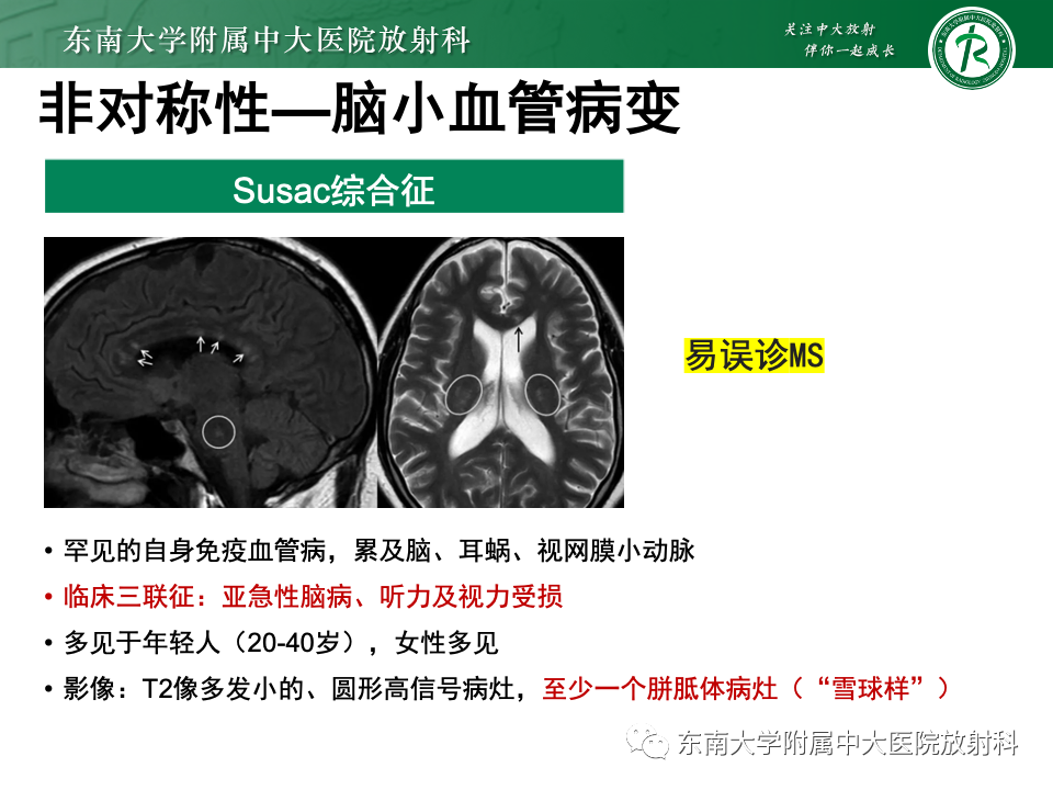 影像PPT - 【PPT】成人常见脑白质病变影像诊断-39