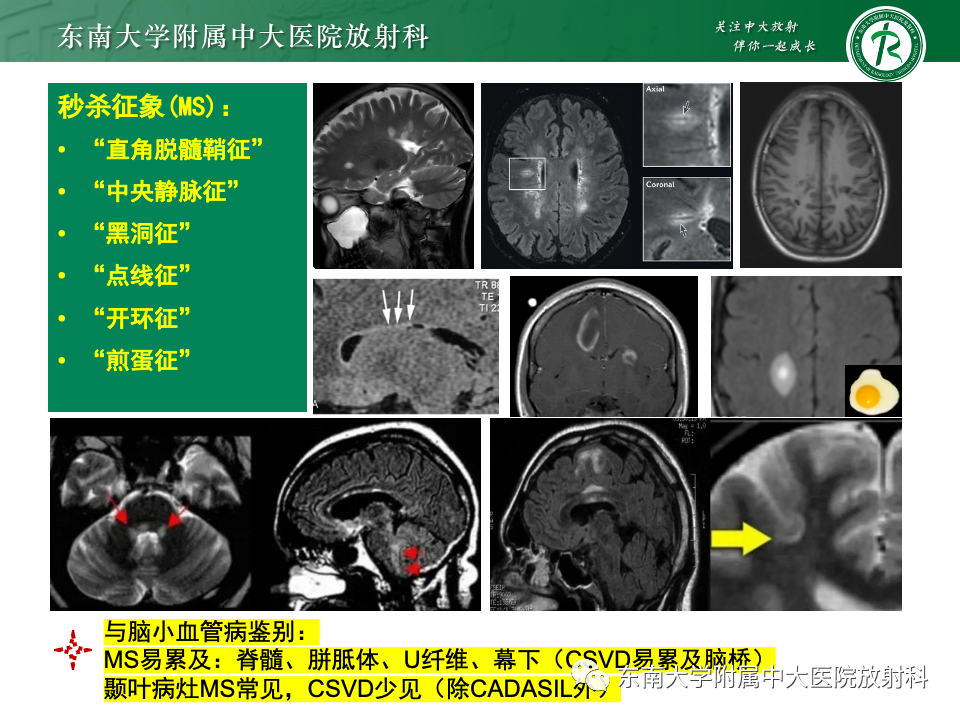 影像PPT - 【PPT】成人常见脑白质病变影像诊断-41