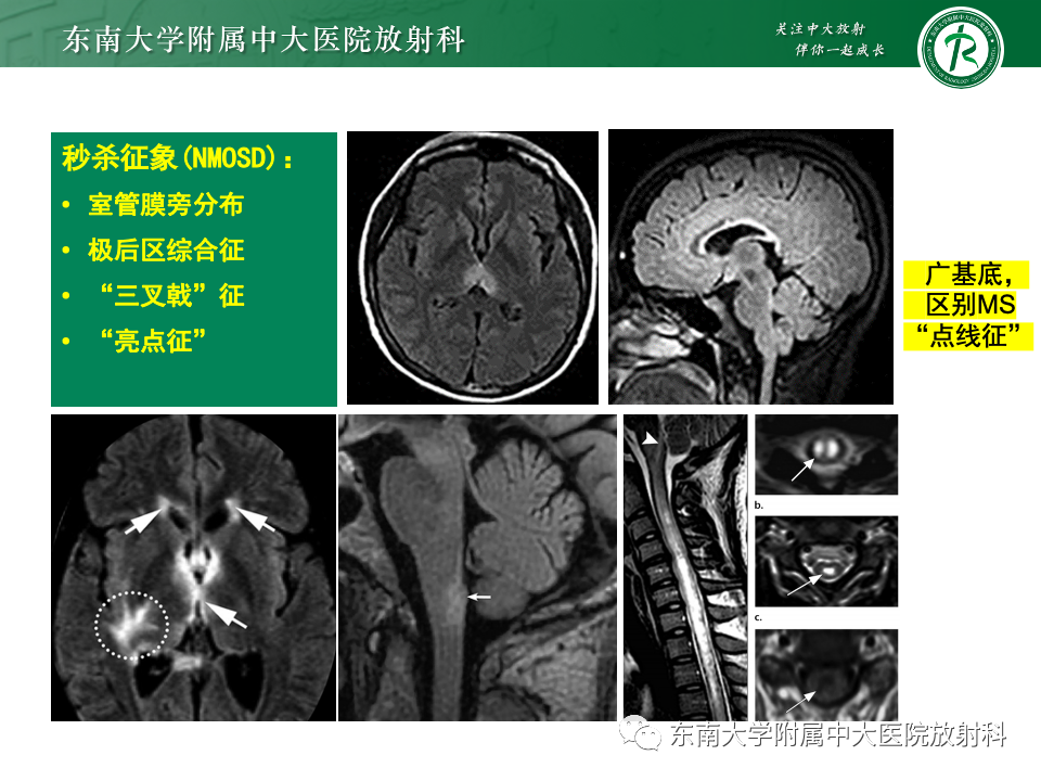 影像PPT - 【PPT】成人常见脑白质病变影像诊断-42