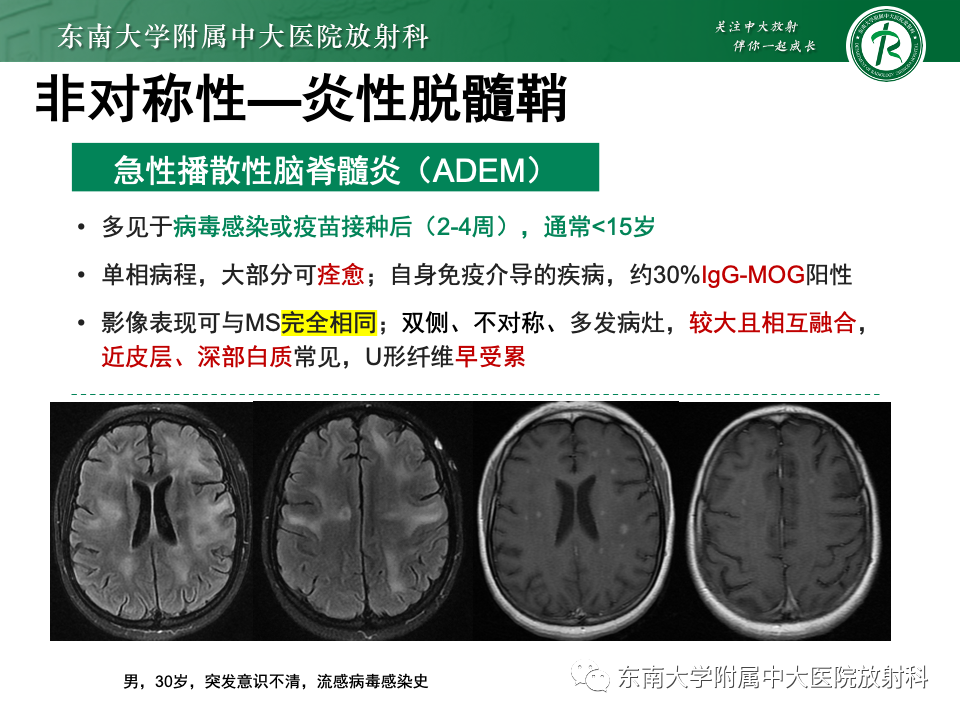 影像PPT - 【PPT】成人常见脑白质病变影像诊断-43