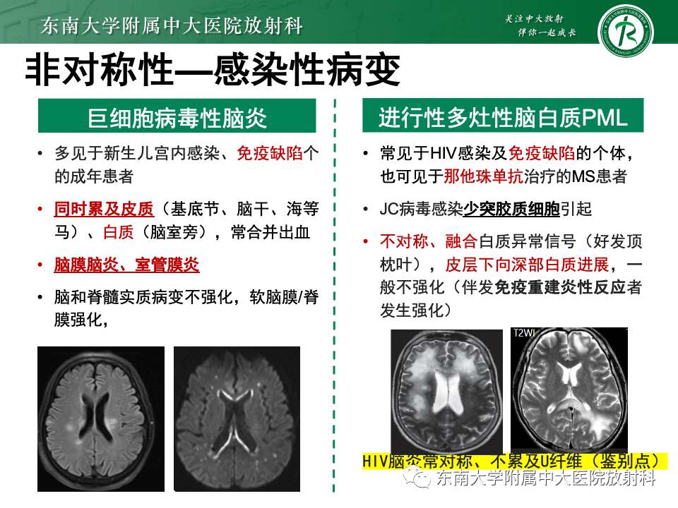 影像PPT - 【PPT】成人常见脑白质病变影像诊断-45