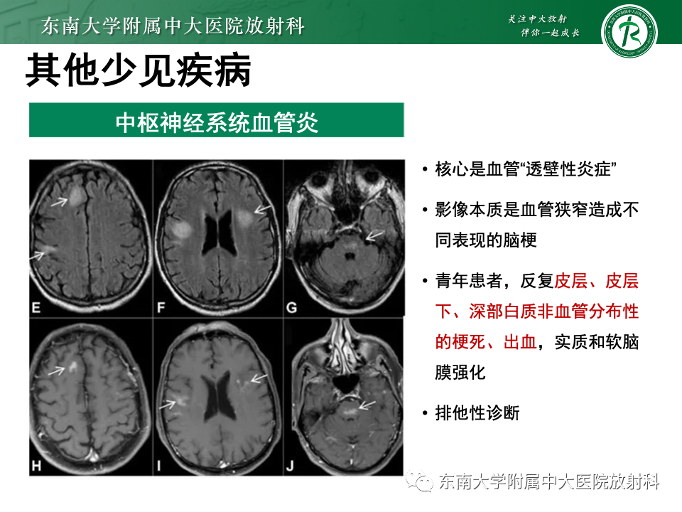 影像PPT - 【PPT】成人常见脑白质病变影像诊断-46