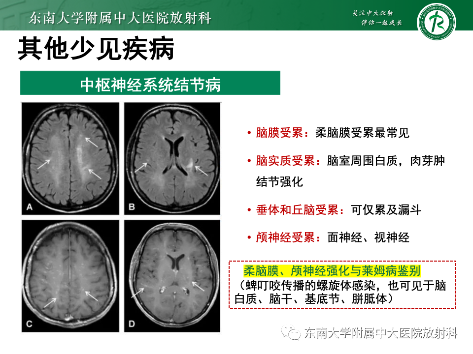 影像PPT - 【PPT】成人常见脑白质病变影像诊断-47