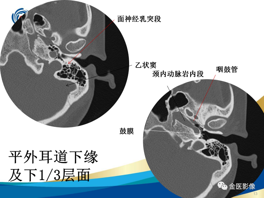 影像PPT - 【PPT】颞骨断层解剖及CT重建-13