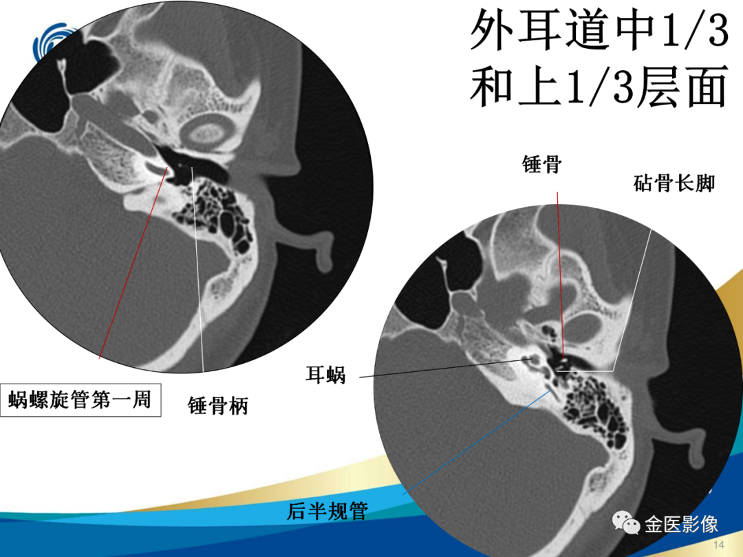 影像PPT - 【PPT】颞骨断层解剖及CT重建-14