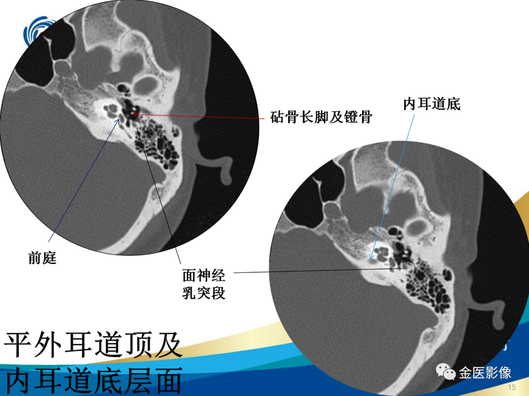 影像PPT - 【PPT】颞骨断层解剖及CT重建-15