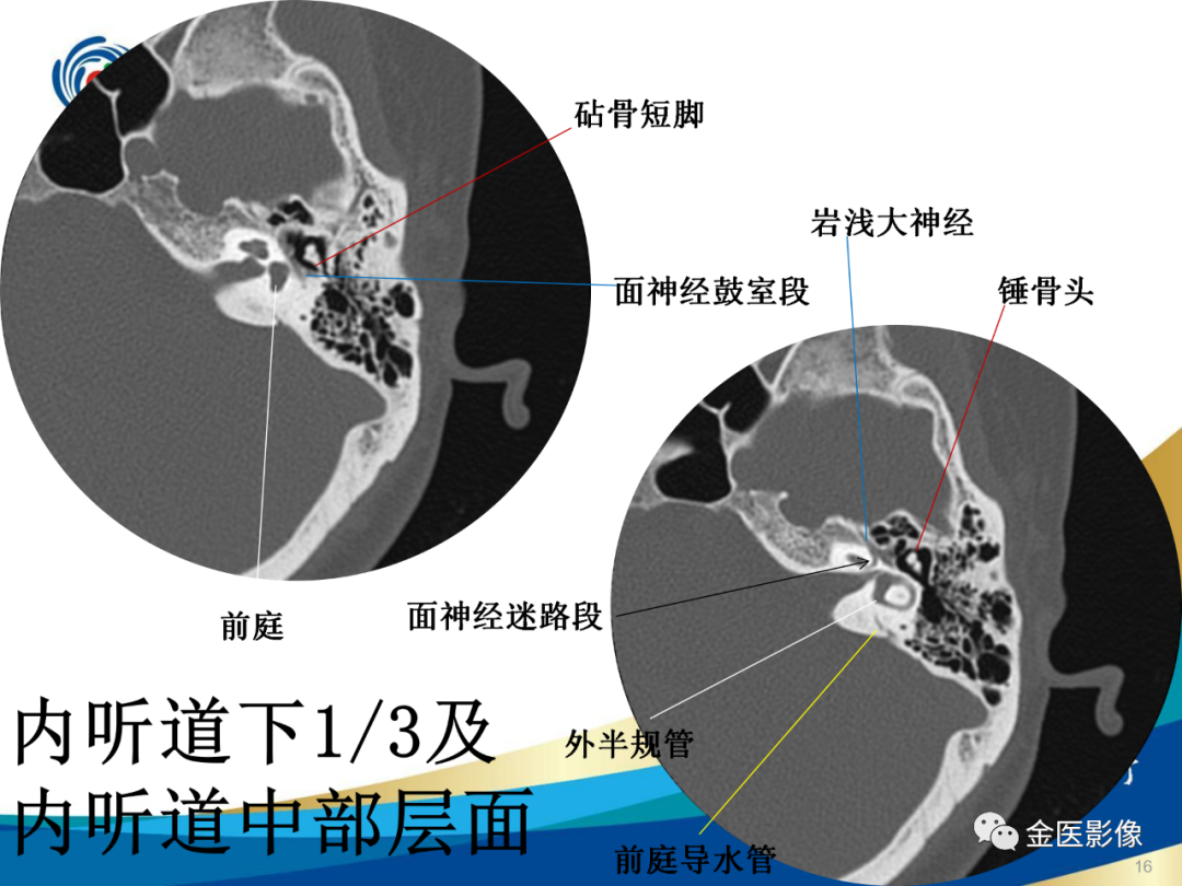 影像PPT - 【PPT】颞骨断层解剖及CT重建-16