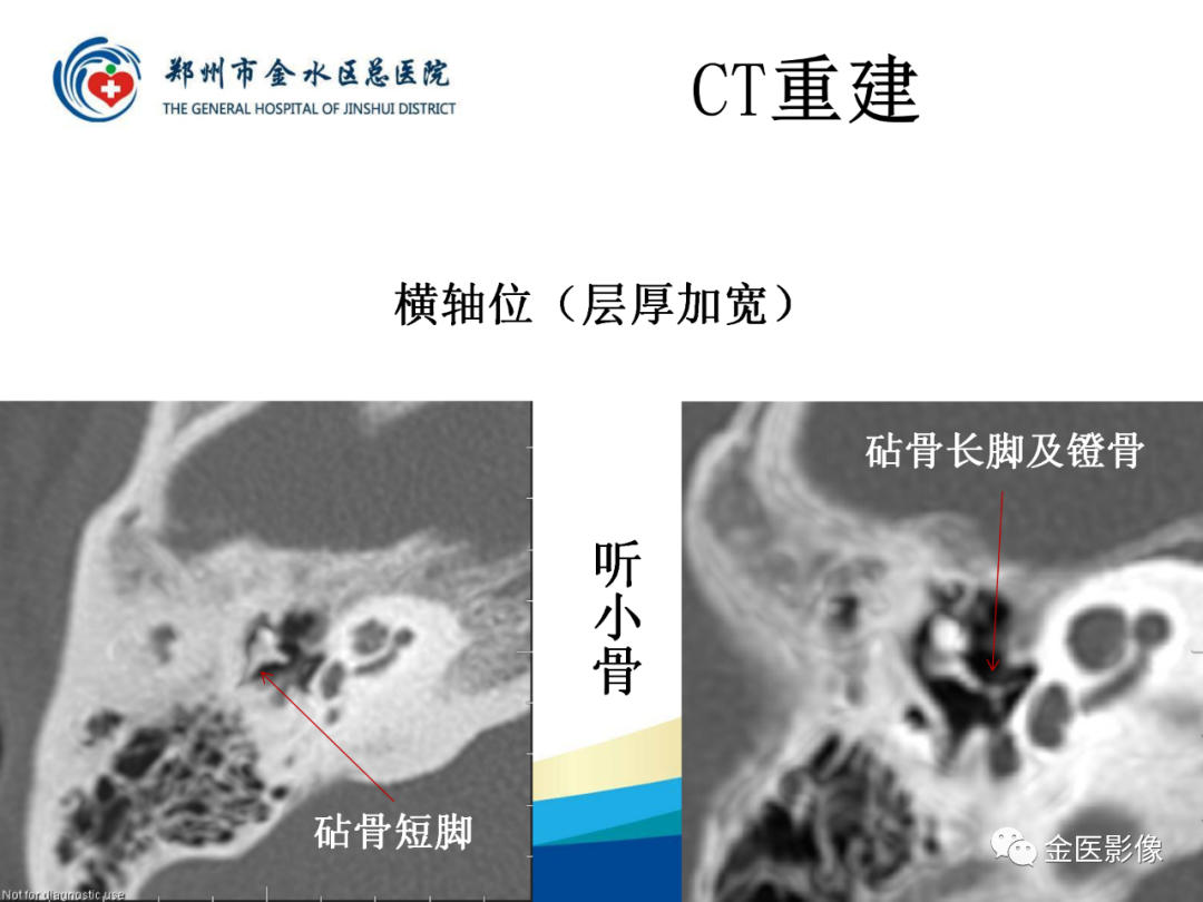 影像PPT - 【PPT】颞骨断层解剖及CT重建-17