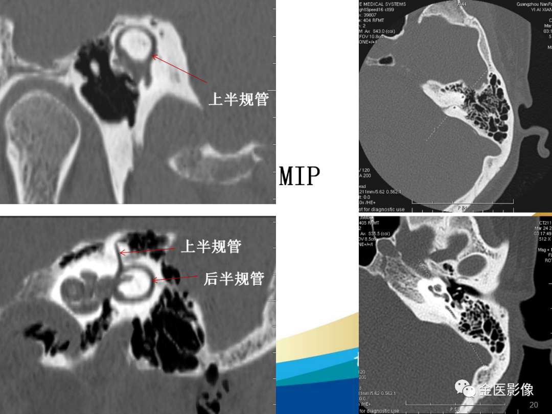 影像PPT - 【PPT】颞骨断层解剖及CT重建-20