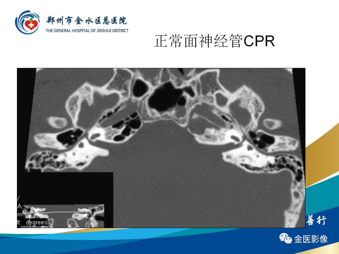 影像PPT - 【PPT】颞骨断层解剖及CT重建-22