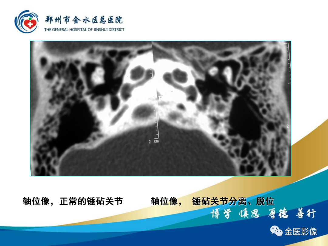 影像PPT - 【PPT】颞骨断层解剖及CT重建-24