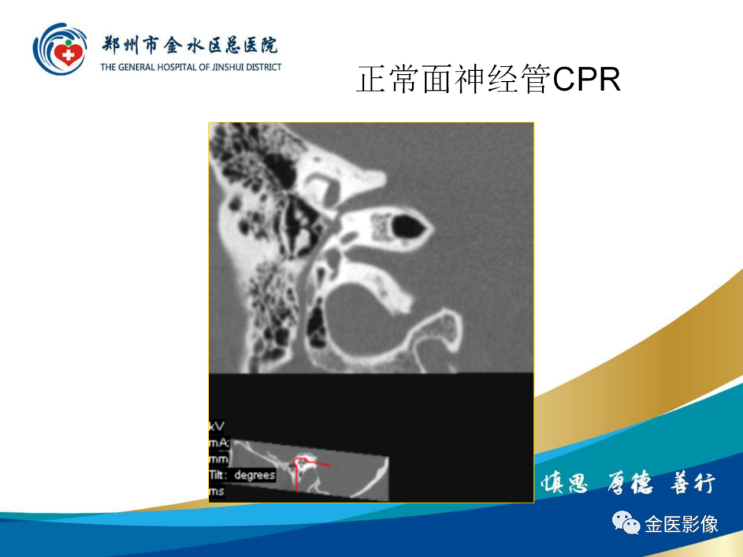 影像PPT - 【PPT】颞骨断层解剖及CT重建-23