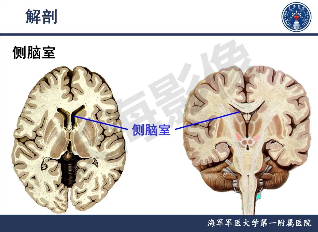 影像PPT - 【PPT】脑室肿瘤-7