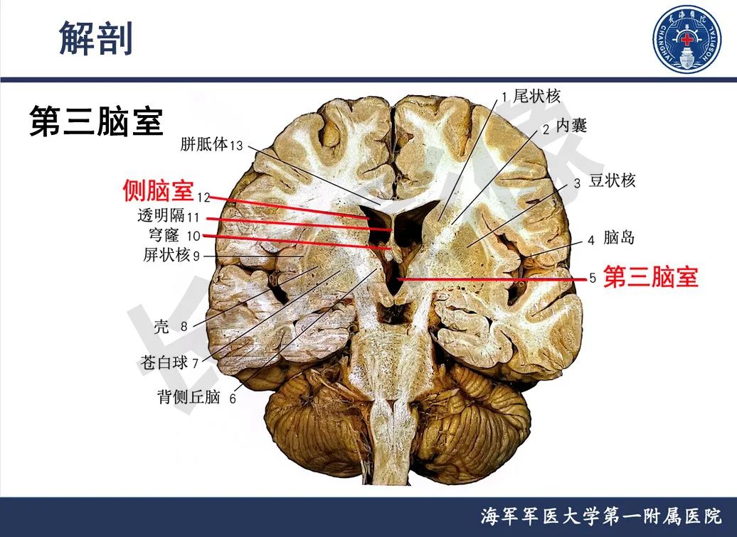 影像PPT - 【PPT】脑室肿瘤-9