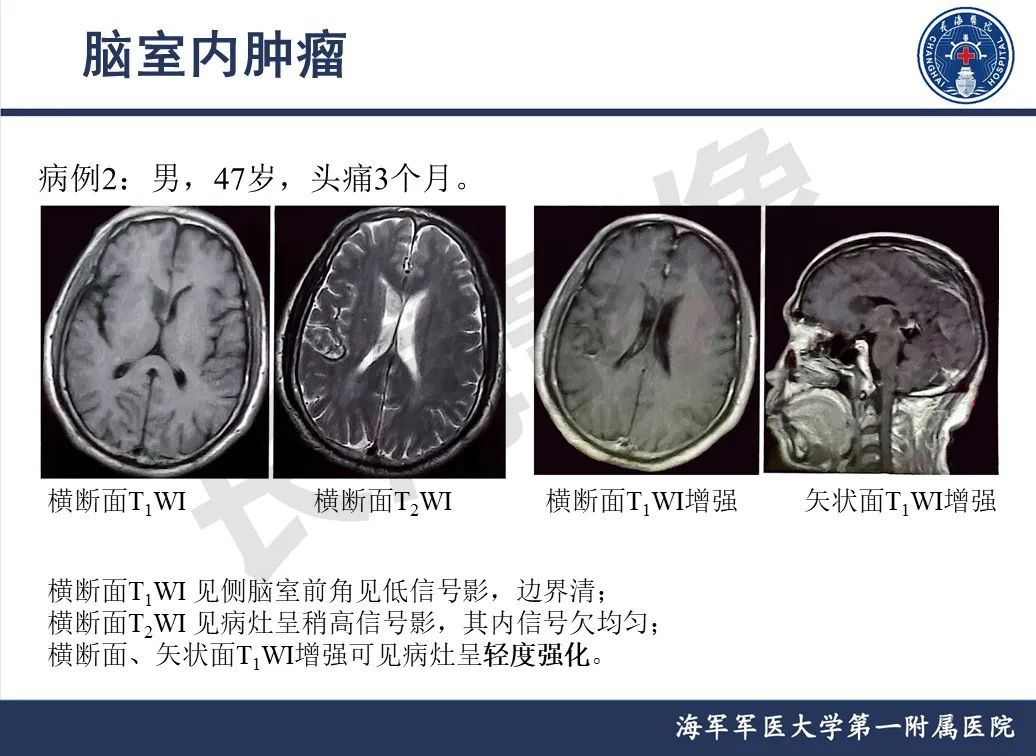 影像PPT - 【PPT】脑室肿瘤-17