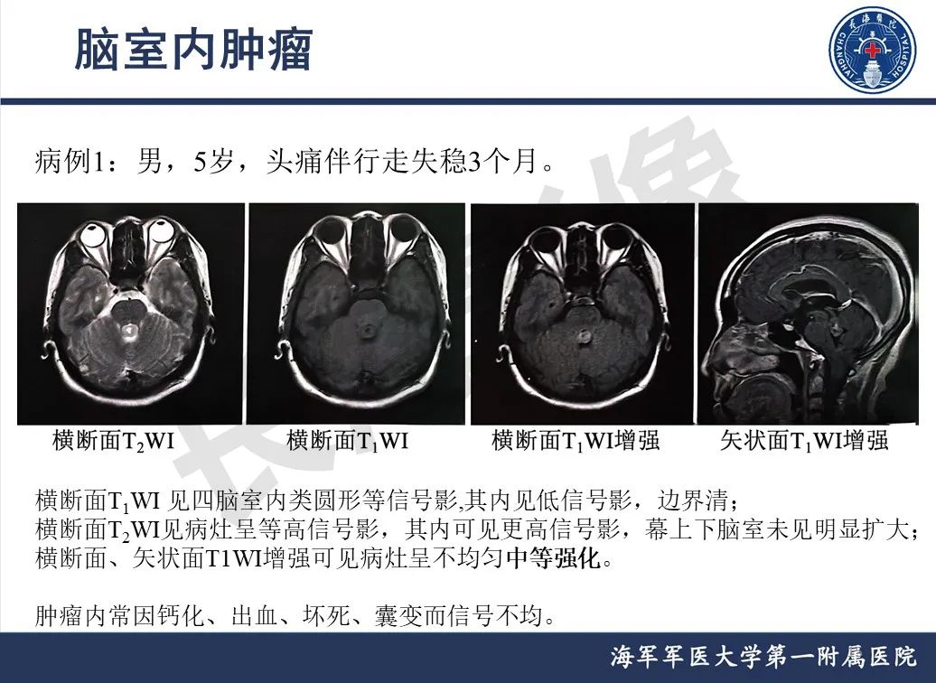 影像PPT - 【PPT】脑室肿瘤-15