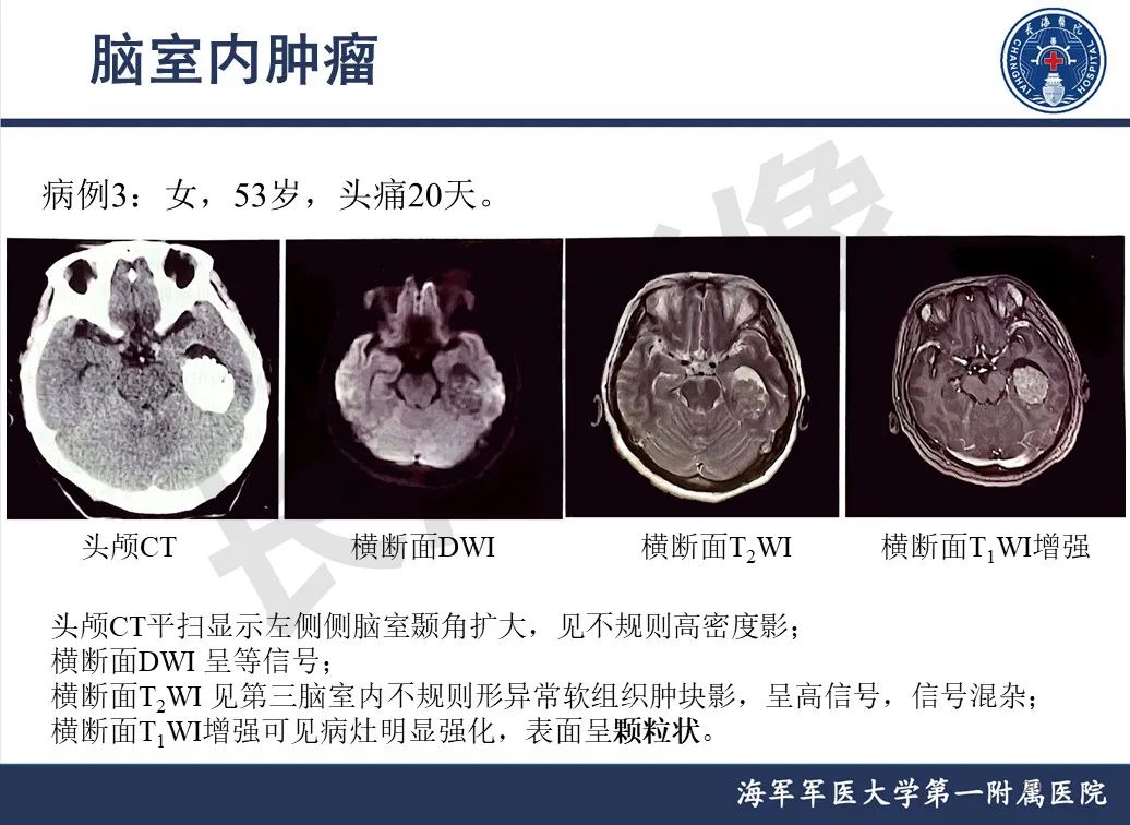 影像PPT - 【PPT】脑室肿瘤-20