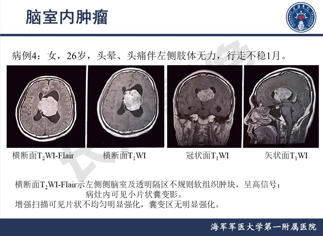 影像PPT - 【PPT】脑室肿瘤-22