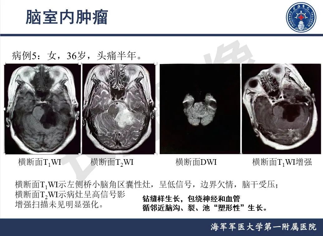 影像PPT - 【PPT】脑室肿瘤-24