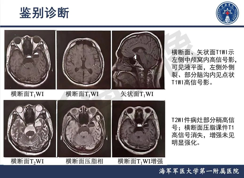 影像PPT - 【PPT】脑室肿瘤-26