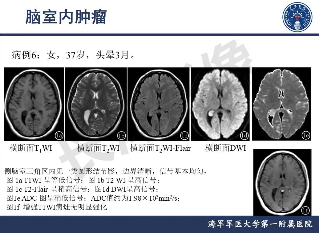 影像PPT - 【PPT】脑室肿瘤-28