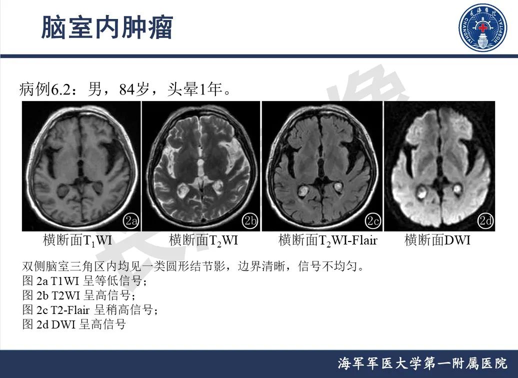 影像PPT - 【PPT】脑室肿瘤-29