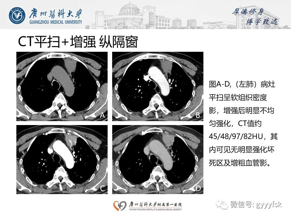影像PPT - 【PPT】机化性肺炎-5