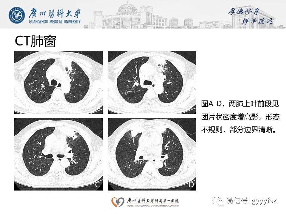 影像PPT - 【PPT】机化性肺炎-4