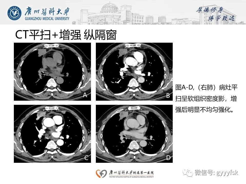 影像PPT - 【PPT】机化性肺炎-6