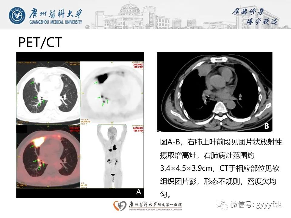 影像PPT - 【PPT】机化性肺炎-8