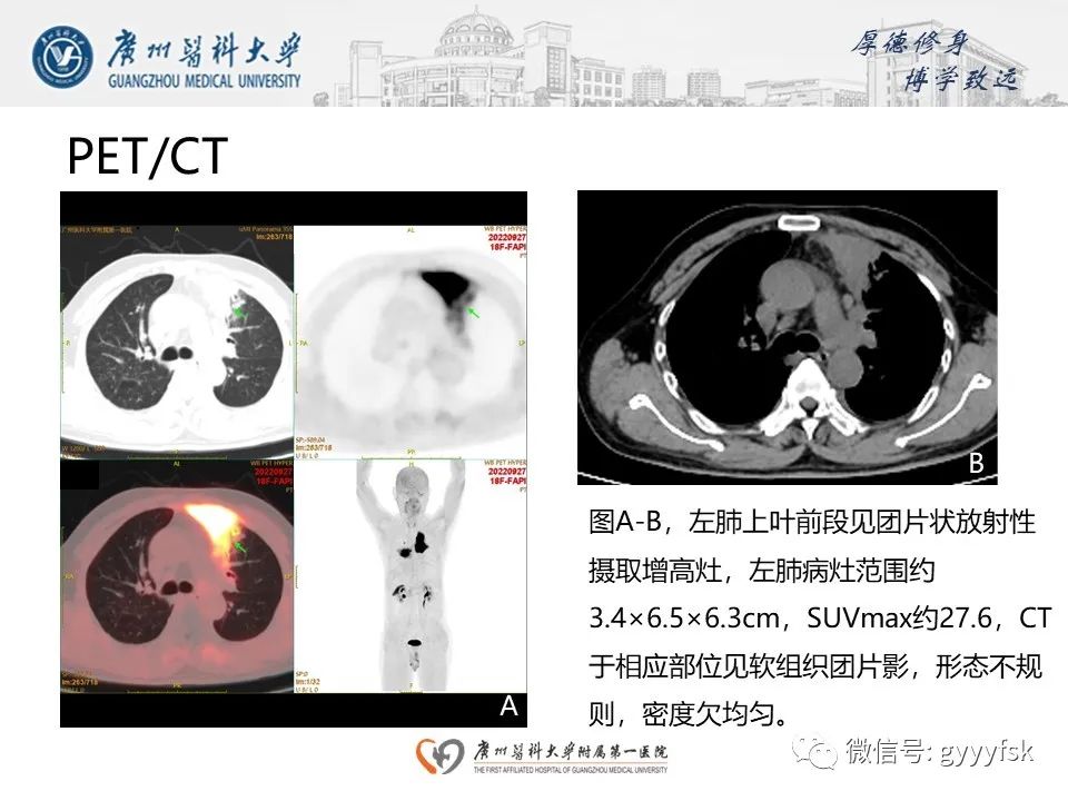 影像PPT - 【PPT】机化性肺炎-7