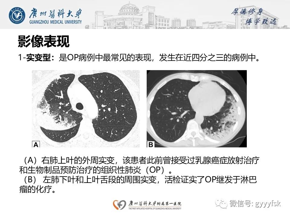 影像PPT - 【PPT】机化性肺炎-15