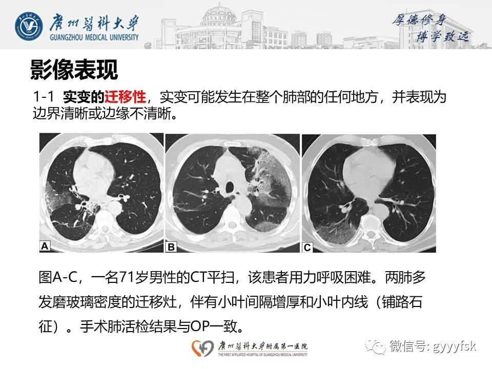 影像PPT - 【PPT】机化性肺炎-16