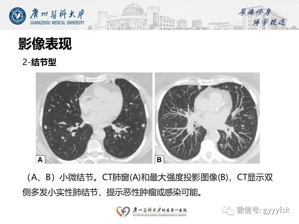 影像PPT - 【PPT】机化性肺炎-18