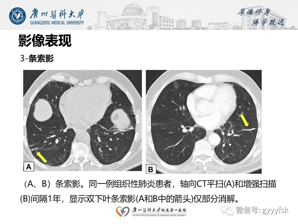 影像PPT - 【PPT】机化性肺炎-19