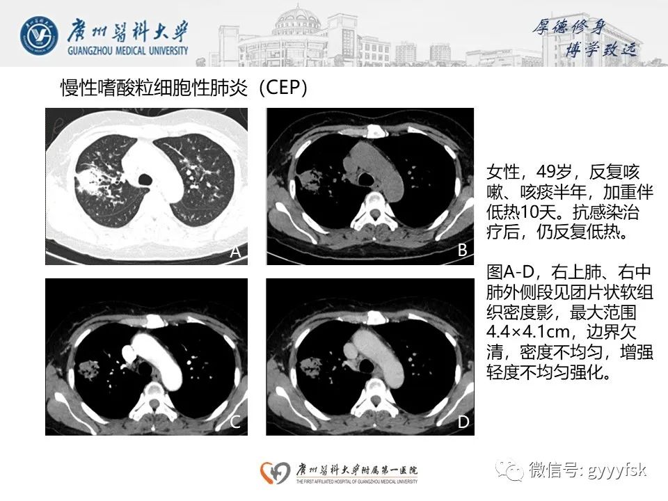 影像PPT - 【PPT】机化性肺炎-21