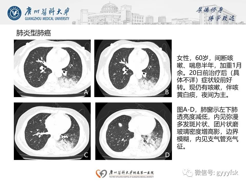 影像PPT - 【PPT】机化性肺炎-23