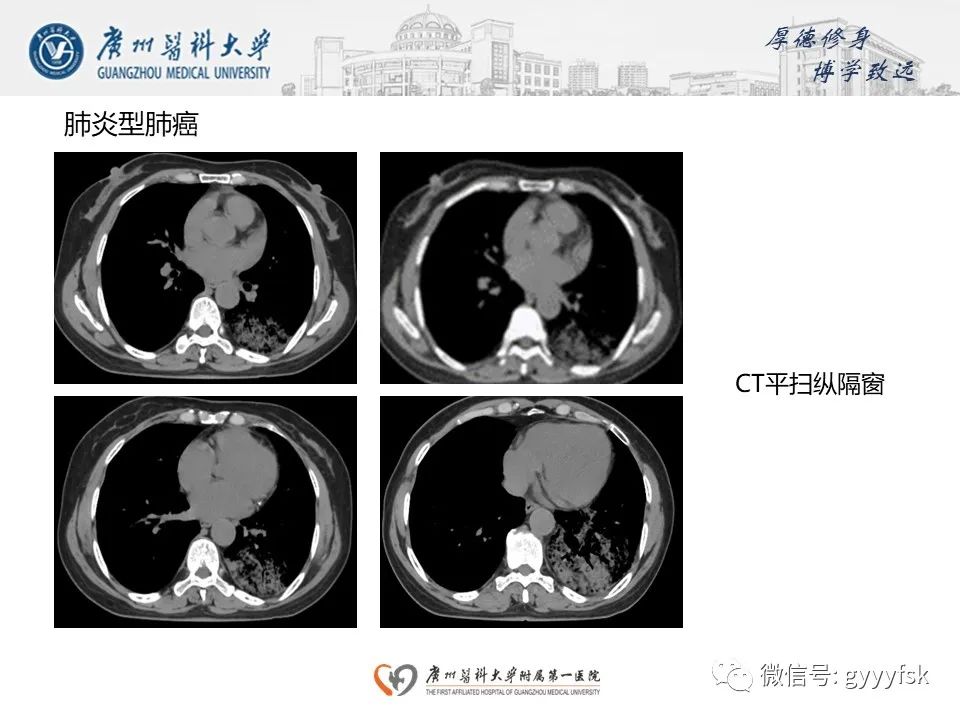 影像PPT - 【PPT】机化性肺炎-24